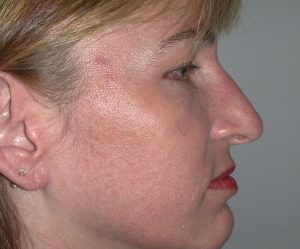 A close-up side profile of a woman with light skin, showing facial texture and subtle signs of plastic surgery.