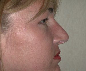 Profile view of a woman’s face with light skin, light hair, and red lipstick, possibly post-plastic surgery.