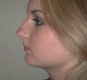 A close-up side profile of a person with light brown hair, possibly considering plastic surgery, against a light background.