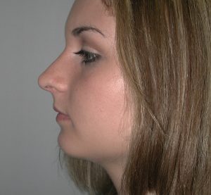 Profile view of a young woman with straight, light brown hair, possibly considering plastic surgery, against a plain background.