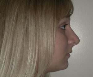 Profile view of a woman with straight blonde hair, highlighting subtle plastic surgery, against a light background.