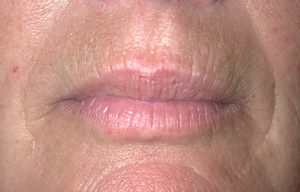 Close-up of a persons lips and skin, showing natural texture, ideal for plastic surgery consultation visuals.