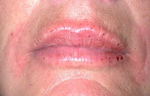 Close-up of lips with redness, dryness, and small cracks, often seen in plastic surgery recovery.