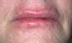 Close-up of dry, cracked lips on a person with fair skin—mild irritation that may benefit from plastic surgery consultation.