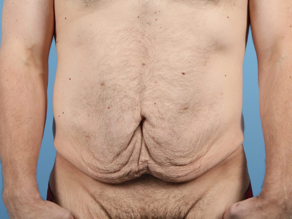 Will Tummy Tuck Scars Go Away, and Does it Remove Fat?