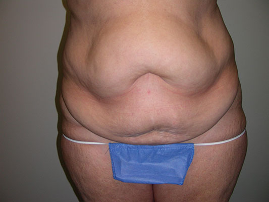 Benefits of a Tummy Tuck After a C-Section in Birmingham, AL