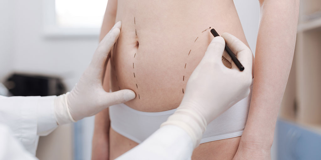 Your Laser Liposuction Recovery Guide