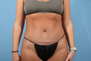 Frontal view of a midsection after a tummy tuck, wearing a grey top and black undergarment against a blue background