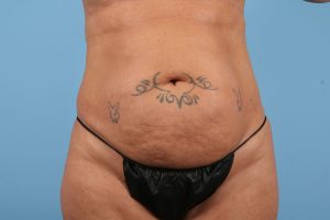 Frontal view of a midsection before a tummy tuck, wearing a black undergarment against a blue background.