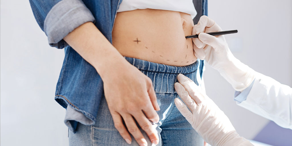 Can I Get a Tummy Tuck After a C-Section?