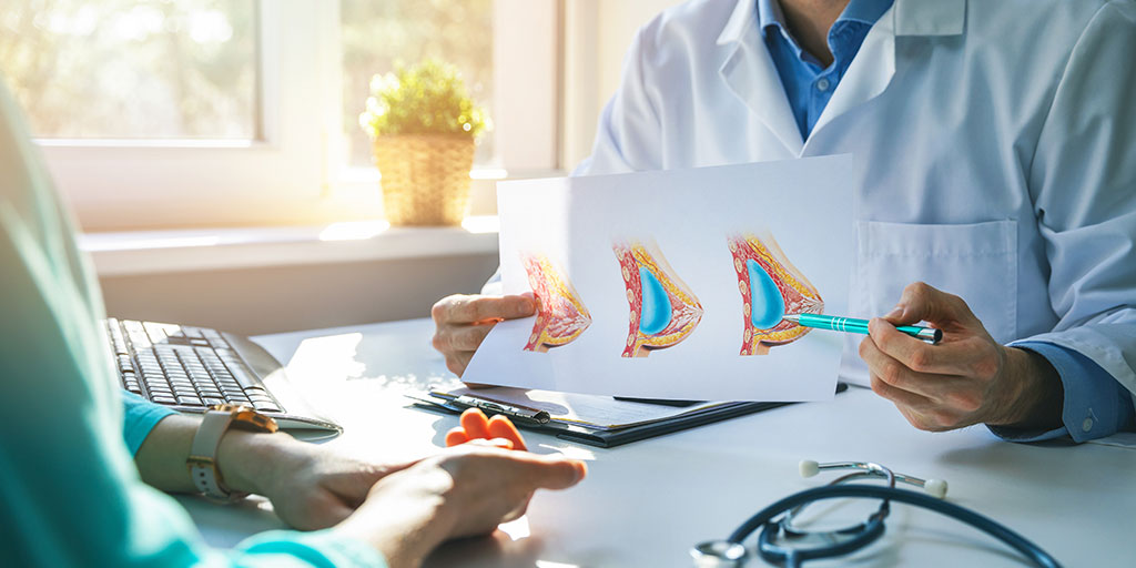 Doctor showing a patient a breast aug. diagram