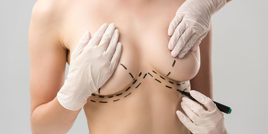 Plastic surgeon marking body for surgery