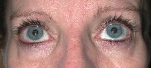 Close-up of a persons blue eyes and upper face, showing dilated pupils, visible eyelashes, and subtle hints of plastic surgery.