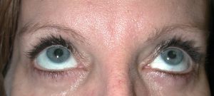 Close-up of a persons blue eyes and forehead, highlighting skin texture, sparse eyebrows, and signs of plastic surgery.