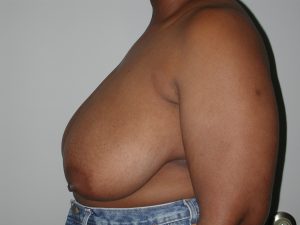 Breast Reduction in Birmingham, AL
