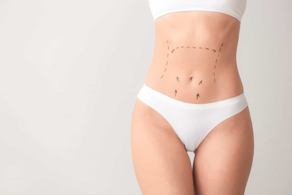 5 Tricks to Help Heal & Fade Tummy Tuck Scars - Boston Plastic Surgery