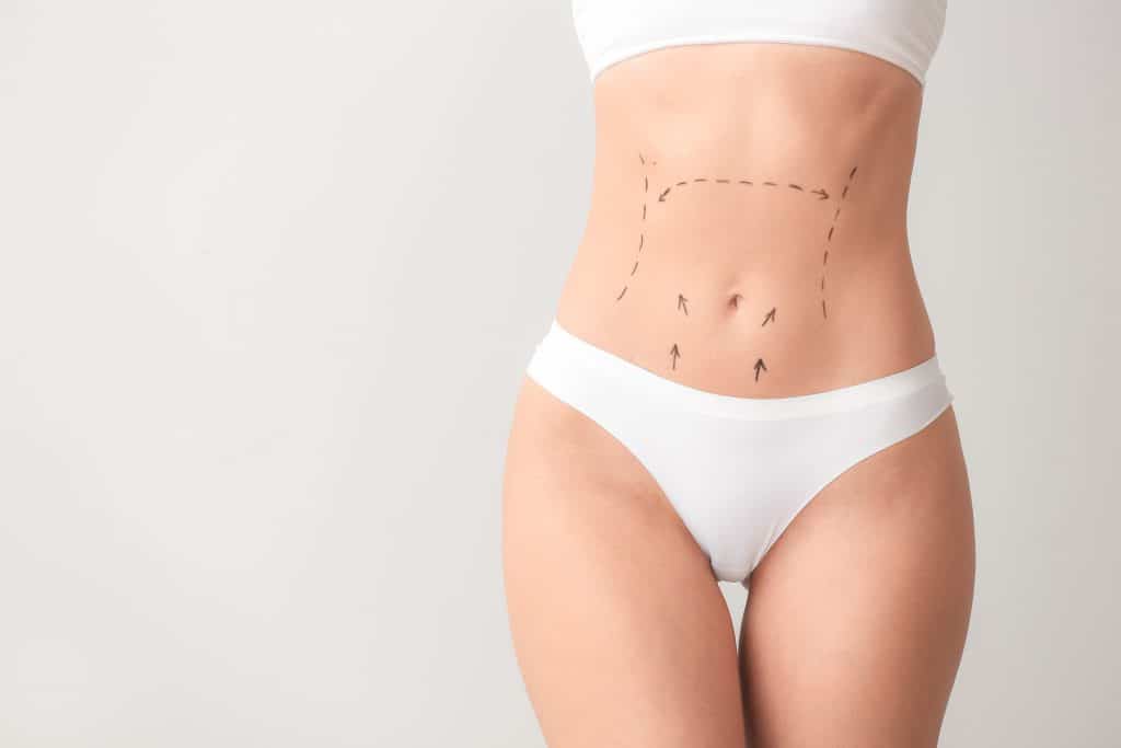 Woman in white underwear with surgical markings on her abdomen, indicating a planned plastic surgery procedure.
