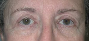 Close-up of an adults face showing both eyes and surrounding skin with visible pores, ideal for plastic surgery reference.