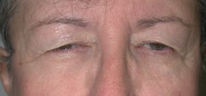 Close-up of a persons face showing drooping eyelids and visible signs of aging, ideal for plastic surgery reference.