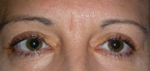 Close-up of a persons eyes with heterochromia and uneven pupils, highlighting skin texture and plastic surgery detail.