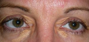 Close-up of a person’s eyes with yellowish plaques on the eyelids, indicative of xanthelasma, treatable with plastic surgery.