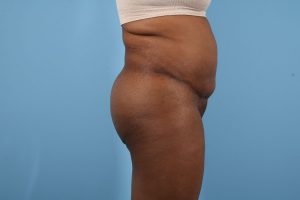 Side view of a woman standing against a blue background, showcasing her torso prior to a brazilian buttock lift.