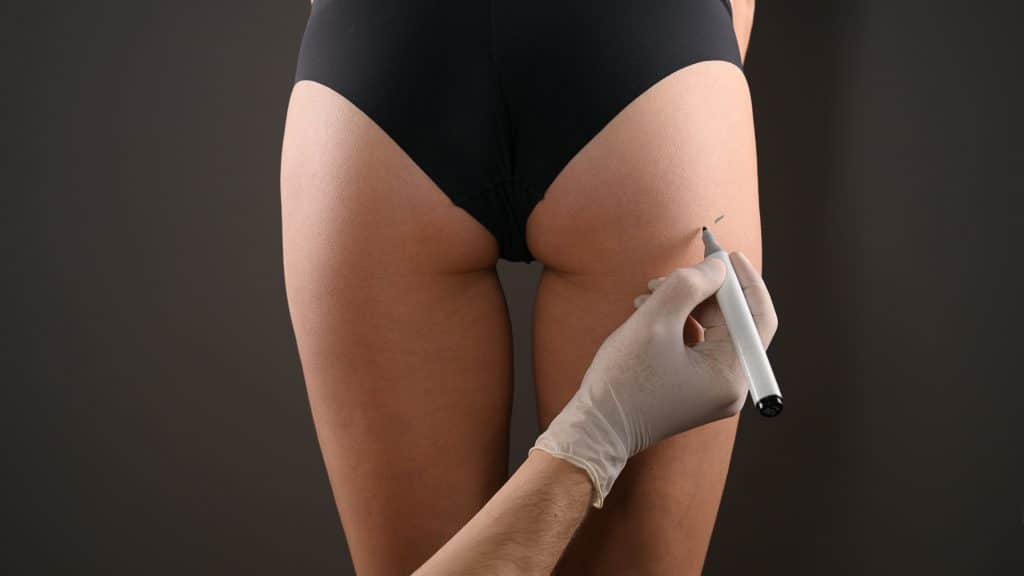 A person in black underwear has plastic surgery marks drawn on their buttock by a gloved hand with a marker.