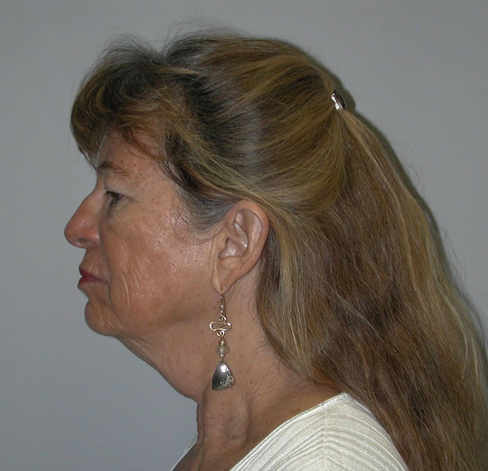 What is a Mini Neck Lift? Birmingham, AL