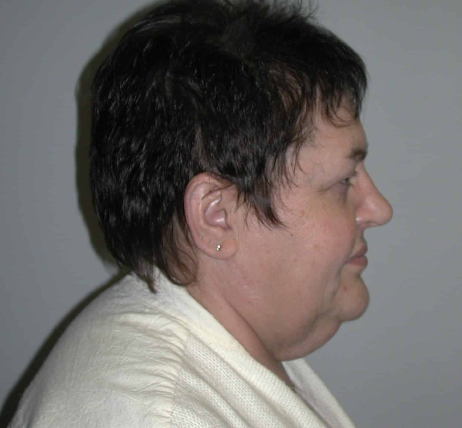 What is a Mini Neck Lift? Birmingham, AL