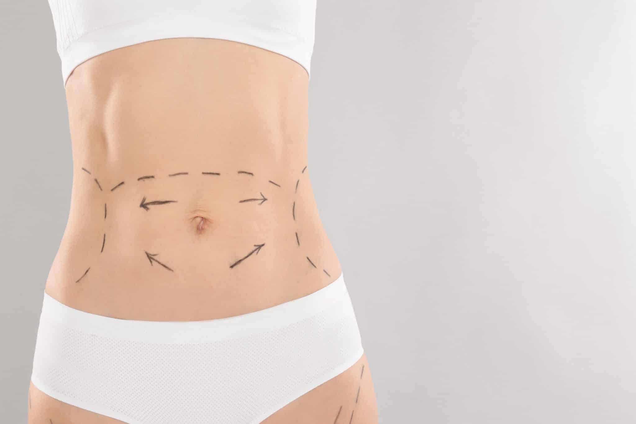 Does Mini Tummy Tuck Lower The Belly Button