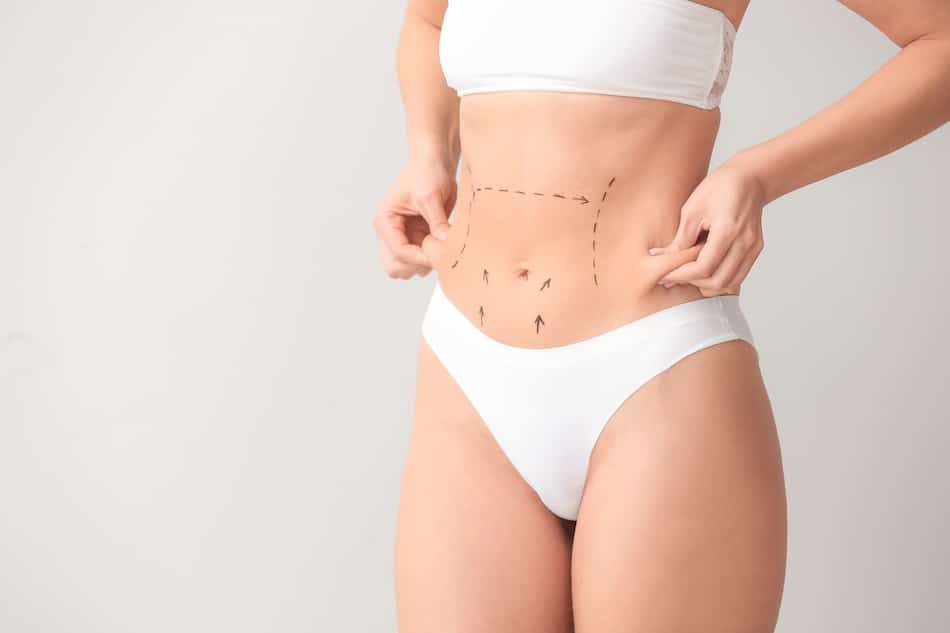 Woman in white underwear displays her midsection with surgical marking lines.