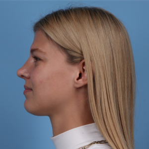 Side view of a woman with straight blonde hair after rhinoplasty, showing post-surgical nose profile.