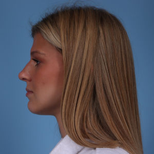 Side view of a woman with straight blonde hair before rhinoplasty, showing natural nose profile.