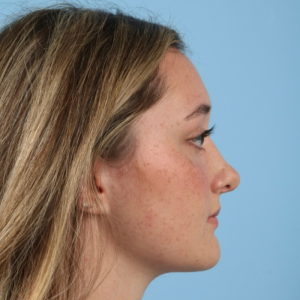 Side view of a woman with long blonde hair after rhinoplasty, showing post-surgical nose profile.
