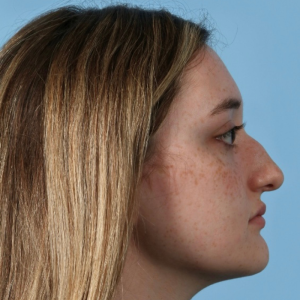 Profile view of a woman with light brown hair and freckles, set against a blue background, highlighting natural beauty post-plastic surgery.