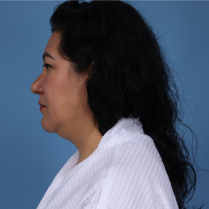 Woman with long dark hair in a white garment, shown in profile against a plain blue background, after plastic surgery.