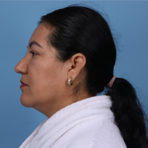 Woman with dark hair in a ponytail, wearing a white robe, shown in profile against a blue background, suggesting plastic surgery.