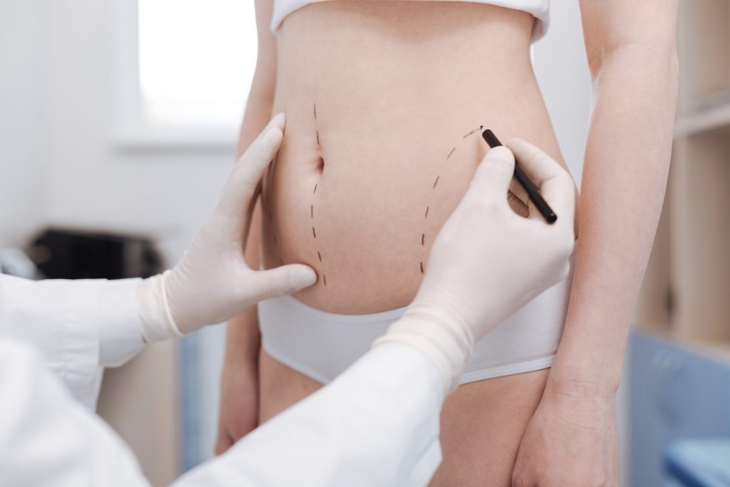 A person marks surgical lines on a womans abdomen, preparing for a cosmetic or medical procedure.