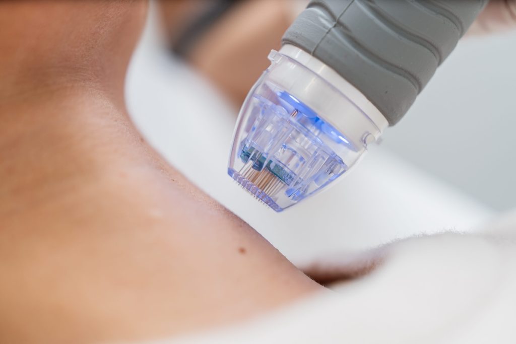A close-up of a microneedling device being applied to a persons neck during a skincare treatment.