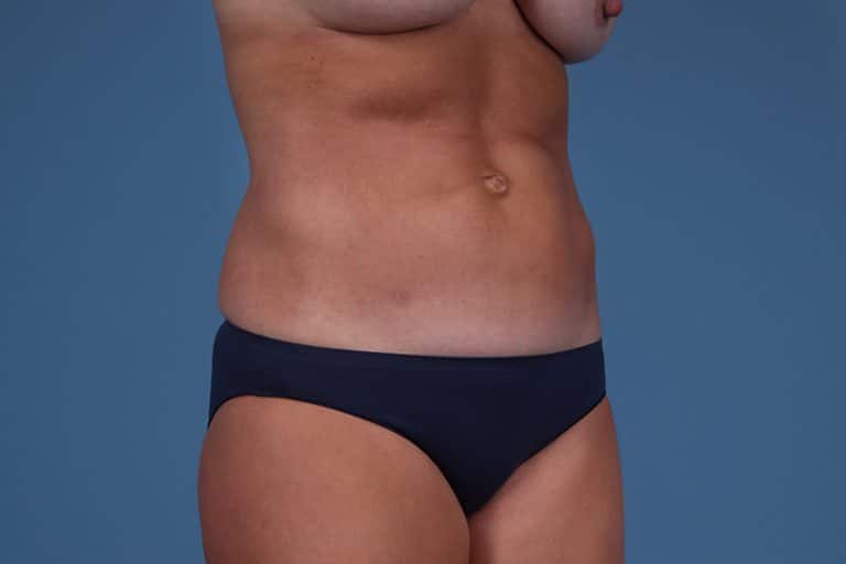 Person wearing dark underwear stands against a blue background, showing torso and upper legs; head and arms not visible.